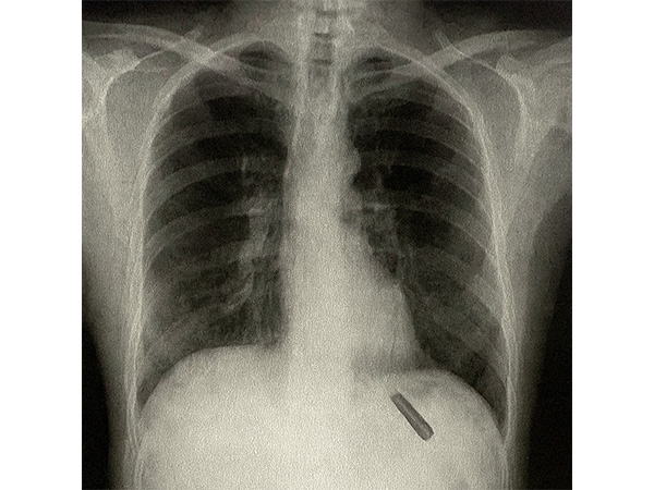 X-ray of the patient (Photo/ANI) X-ray of the patient (Photo/ANI)