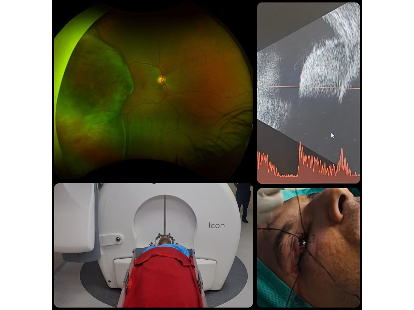 Army Hospital R&R performs Gamma Knife Therapy in 38-year-old serving officer (Photo/X/@SpokespersonMoD) Army Hospital R&R performs Gamma Knife Therapy in 38-year-old serving officer (Photo/X/@SpokespersonMoD)