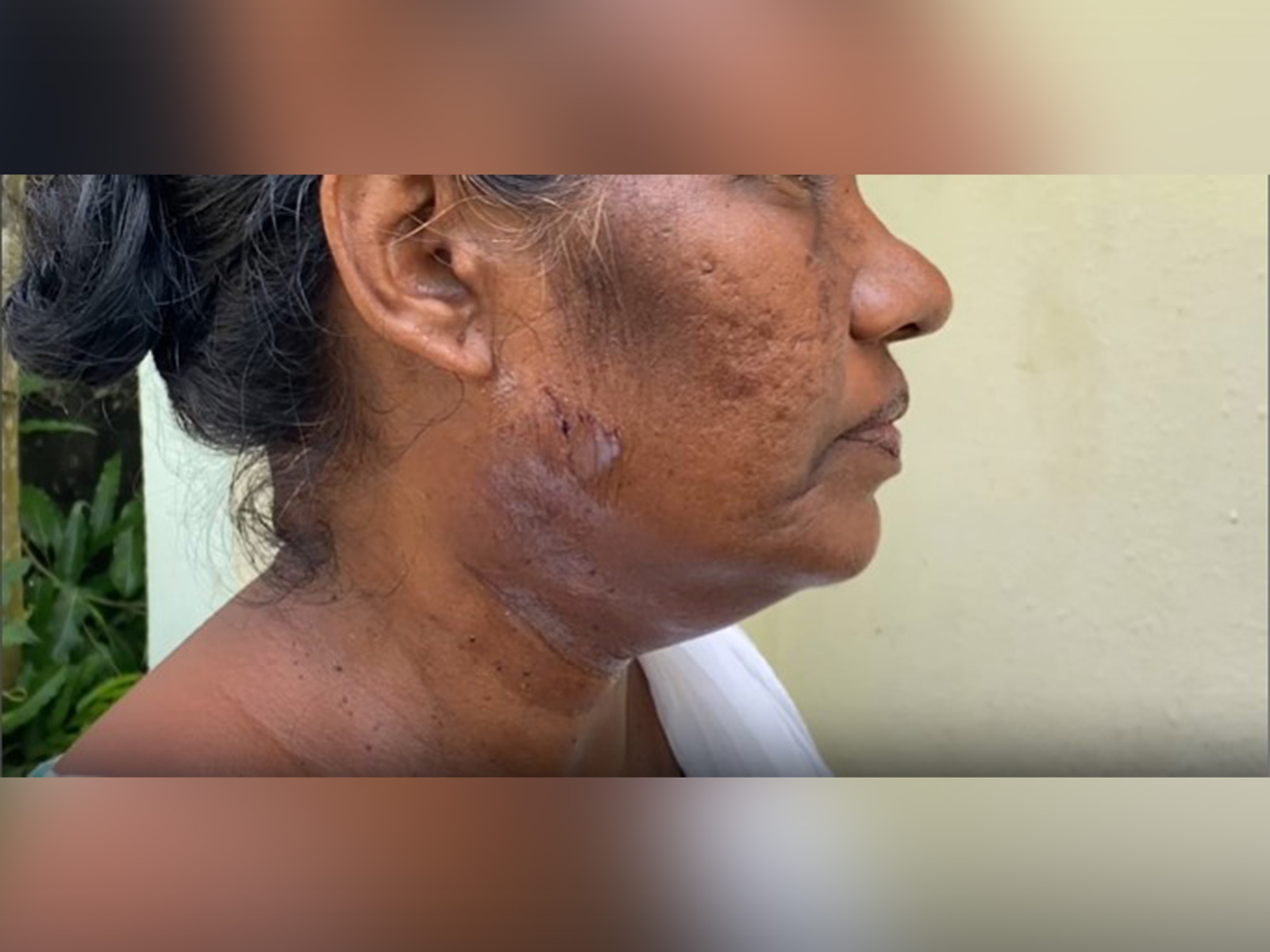 Booth Level Officer in Kottayam, Kerala claimed dog attack during SIR enumeration process (Photo/ANI) Booth Level Officer in Kottayam, Kerala claimed dog attack during SIR enumeration process (Photo/ANI)