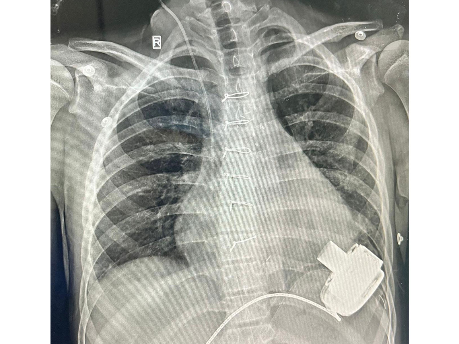 Left Ventricular Assist Device (LVAD) (Photo/ANI)