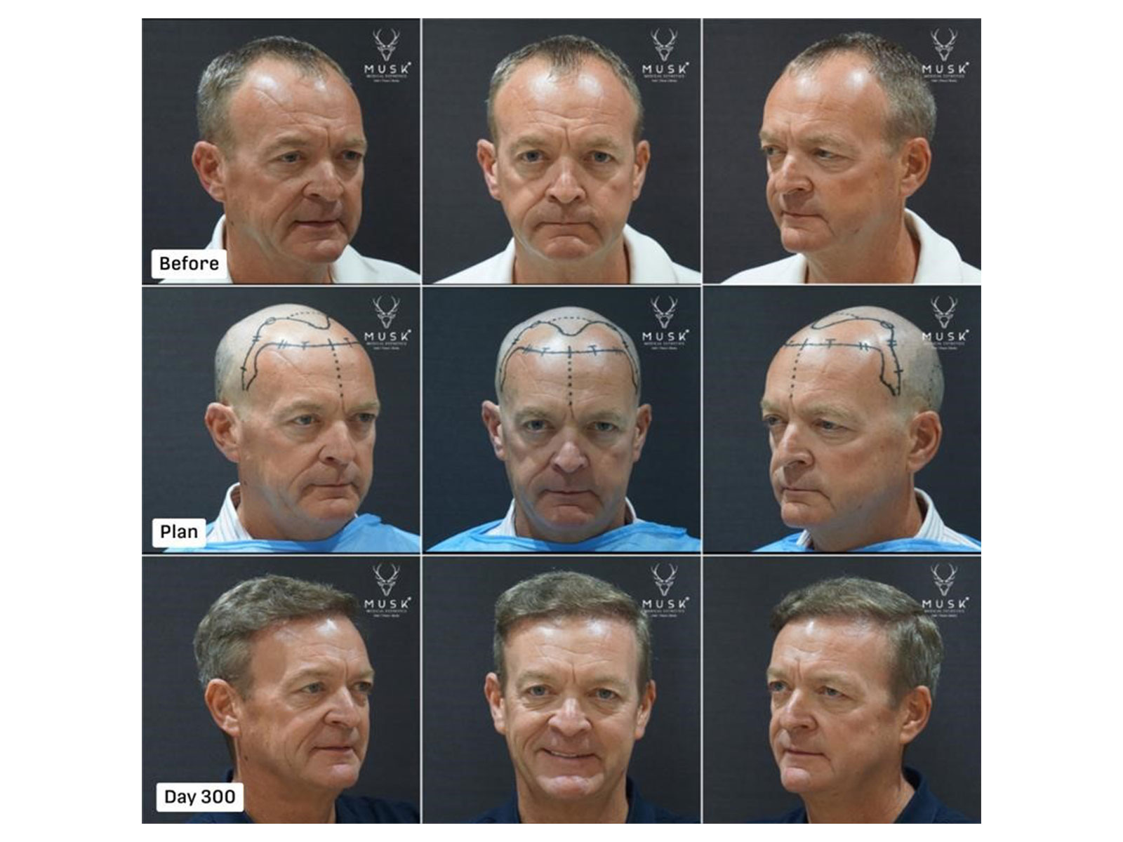 Patient from Ireland, ARTAS Robotic FUE with 2,611 Hair Grafts (Before-After Hair Transplant Result) Patient from Ireland, ARTAS Robotic FUE with 2,611 Hair Grafts (Before-After Hair Transplant Result)