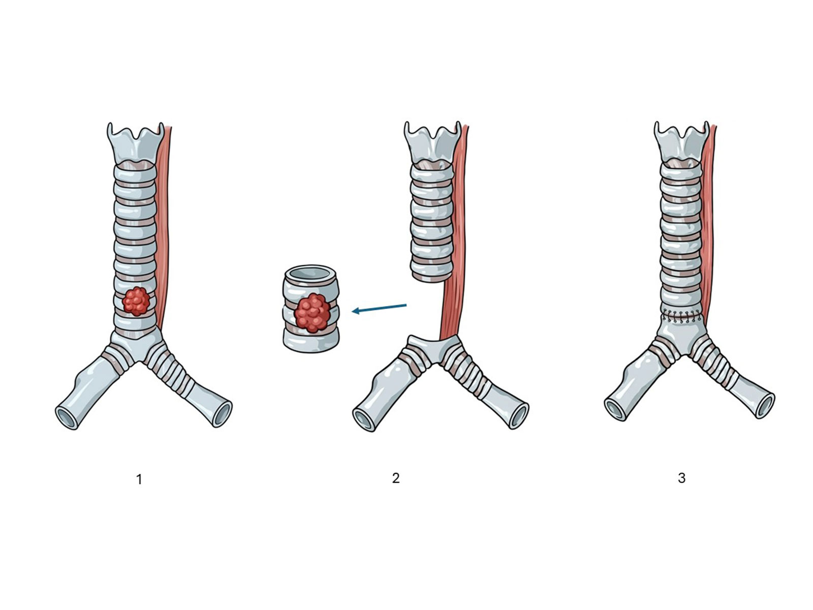 Robotic intrathoracic (chest cavity) cancer surgery