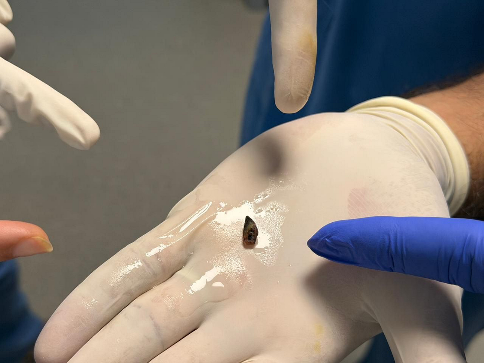 The tiny piece of betel nut removed from the child's airway (Photo/ANI)