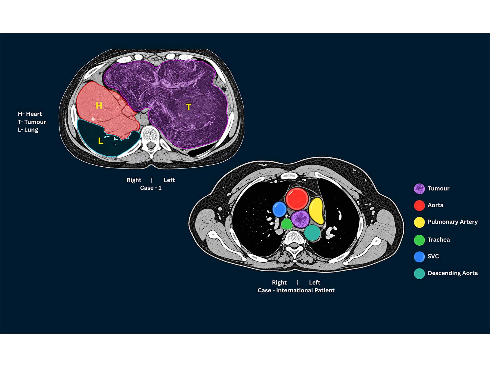 (L) Case 1: CT scan image showing tumour that has pushed the heart to the right (R) Case (International pt.): CT scan image highlighting the tumour and surrounding vessels (L) Case 1: CT scan image showing tumour that has pushed the heart to the right (R) Case (International pt.): CT scan image highlighting the tumour and surrounding vessels